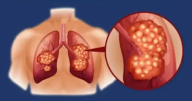 Akciğer Adenokarsinomu: Belirtileri, Nedenleri ve Tedavisi