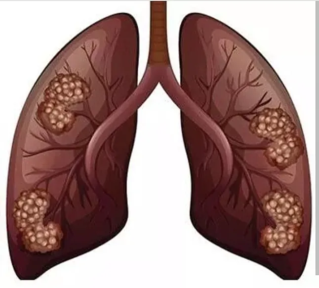 Akciğer Adenokarsinomu: Belirtileri, Nedenleri ve Tedavisi