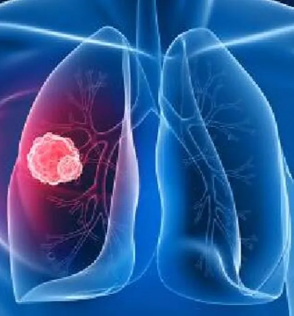 Akciğer Adenokarsinomu: Belirtileri, Nedenleri ve Tedavisi