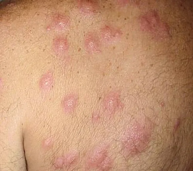 Akut Febril Nötrofilik Dermatoz (Sweet Sendromu) Nedir?