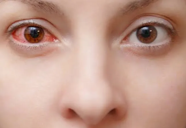 Kırmızı Göz Hastalığı Nedir? Konjonktivit Hastalığı 