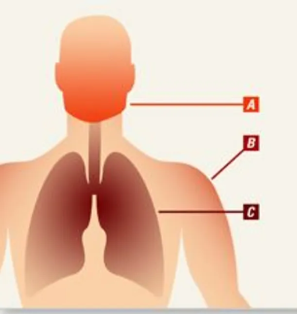 Guillan Barre Sendromu Nedir ?