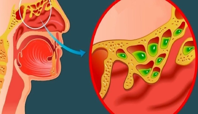 Sinüzit nedir? Sinüzit belirtileri nelerdir?