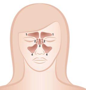 Sinüzittin Yenilenmesinden Korunmanın Yolları Nelerdir?