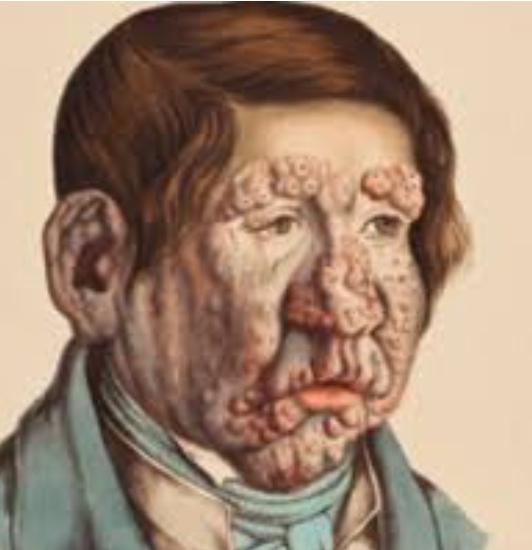 Leprosy Dream Meanings